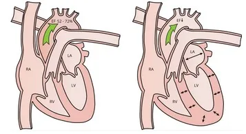 Saving the Heart of a Bodybuilder